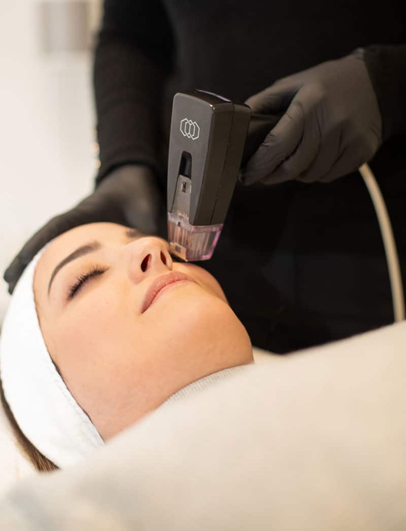 Tratamiento de microneedling en Marbella - España para rejuvenecimiento facial.