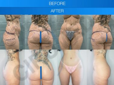 Before and after results of a buttock augmentation performed at Cirumed Clinic, Marbella, Spain.