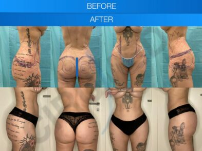 Result of liposuction of the abdomen and buttocks performed in Marbella, Spain.