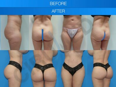Result of a buttock augmentation performed in Marbella - Spain.