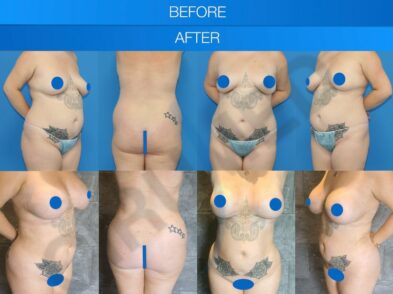 Breast augmentation results in Marbella - Spain.