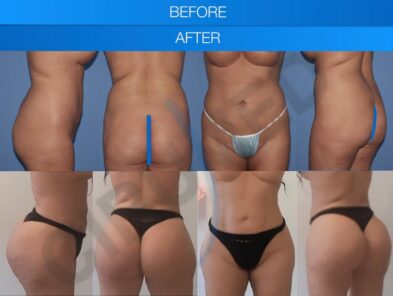 Results of a buttock augmentation performed in Marbella, Spain.