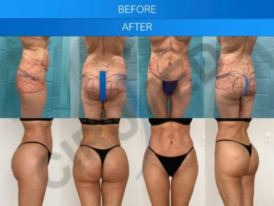 Before and after abdominal liposuction in Marbella, Spain.
