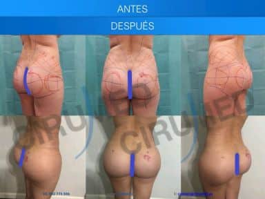 Result of a buttock augmentation performed in Marbella - Spain.