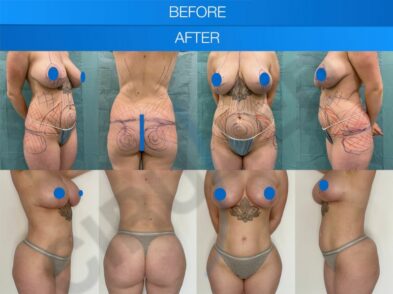 Before and after liposuction and breast augmentation in Marbella, Spain.