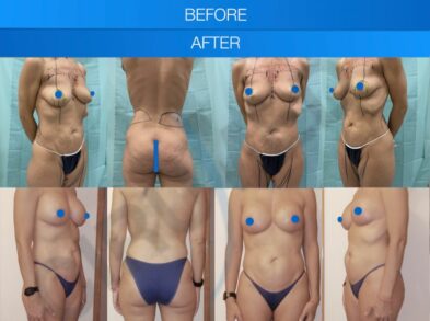 Before and after breast augmentation surgery in Marbella, Spain.