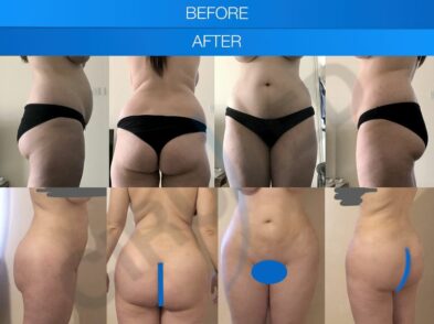 Results of liposuction and buttock augmentation in Marbella, Spain.