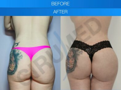 Result of buttock augmentation performed in Marbella - Spain.