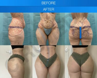 Results of a buttock augmentation performed in Marbella, Spain.