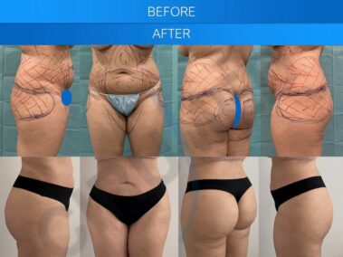 Before and after results of abdominal liposuction in Marbella, Spain.