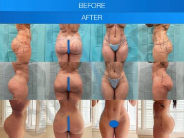 Before and after a buttock augmentation performed in Marbella, Spain.