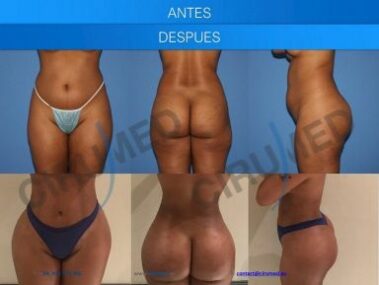Result of buttock augmentation performed in Marbella - Spain.