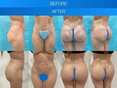 Before and after buttock augmentation surgery in Marbella, Spain.