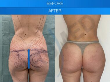 Result of buttock augmentation performed in Marbella - Spain.
