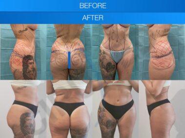Result of a buttock liposuction performed in Marbella - Spain.