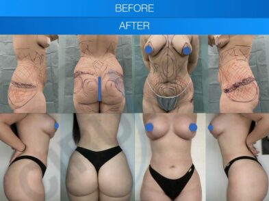 Before and after breast augmentation and liposuction in Marbella, Spain.