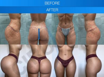 Result of buttock augmentation performed in Marbella - Spain.