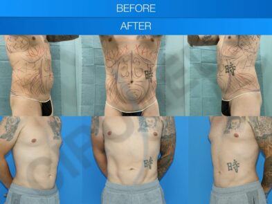 Abdominal liposuction results in Marbella - Spain.