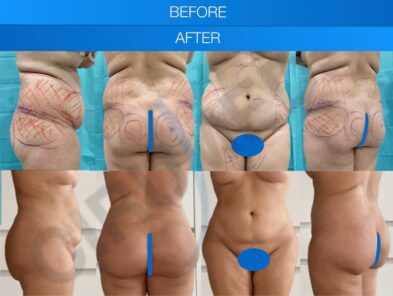 Results of abdominal liposuction in Marbella, Spain.