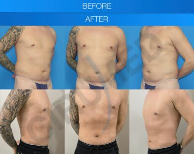 Before and after male liposuction performed in Marbella, Spain.