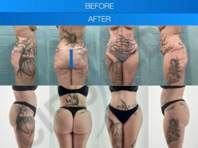 Before and after a buttock augmentation performed in Marbella, Spain.