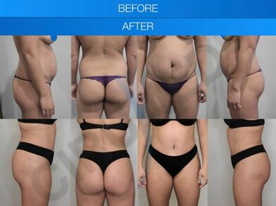 Results of abdominal liposuction in Marbella, Spain.