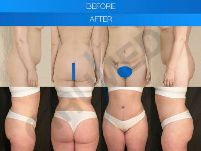 Before and after liposuction in Marbella, Spain.