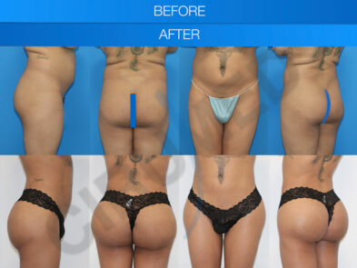 Result of abdominal liposuction and buttock augmentation in Marbella, Spain.