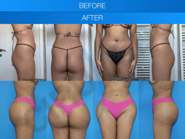 Result of buttock augmentation performed in Marbella - Spain.