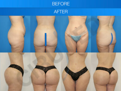 Result of a buttock augmentation performed in Marbella - Spain.