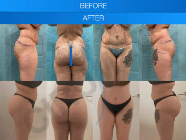 Before and after a liposuction procedure in Marbella, Spain.