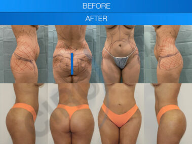 Results of abdominal liposuction in Marbella, Spain.