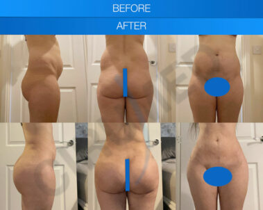 Before and after a buttock augmentation performed in Marbella, Spain.