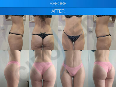 Result of buttock augmentation performed in Marbella - Spain.