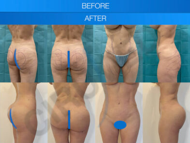 Result of a buttock liposuction performed in Marbella - Spain.