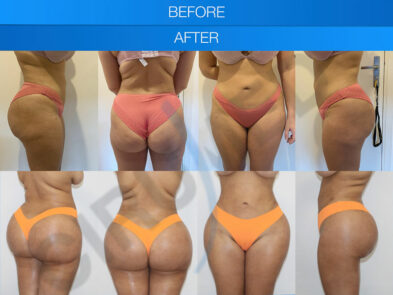 Result of buttock augmentation performed in Marbella - Spain.