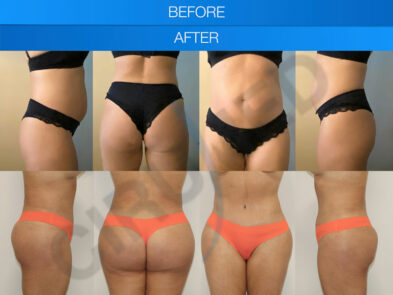 Result of a buttock augmentation performed in Marbella - Spain.