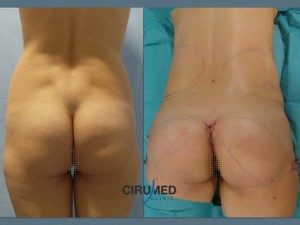 Resultado de aumento de glúteos realizado en Marbella - España.