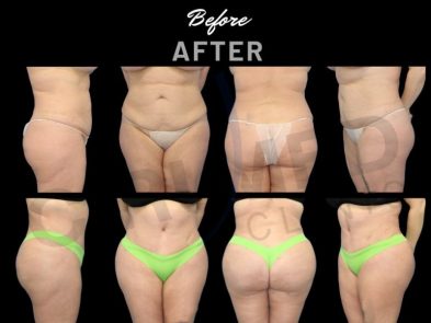 Antes y después de un procedimiento de liposucción en Marbella - España.