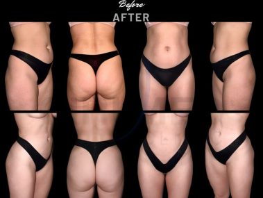 "Hip and thigh liposuction results in Marbella, Spain."