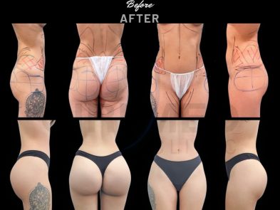Result of a buttock augmentation performed - bbl before and after