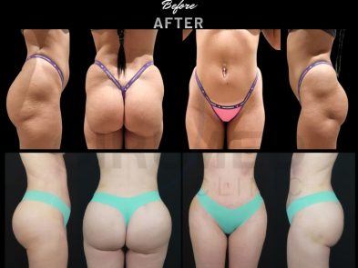 Result of buttock augmentation performed in Marbella - Spain.