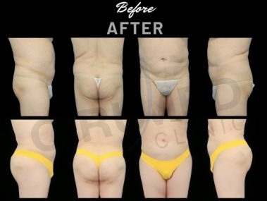 Result of abdominal liposuction at Cirumed Clinic, Marbella - Spain.