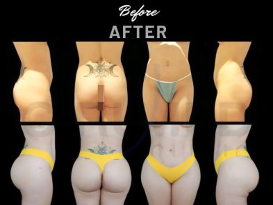 Result of a buttock augmentation performed in Marbella - Spain.