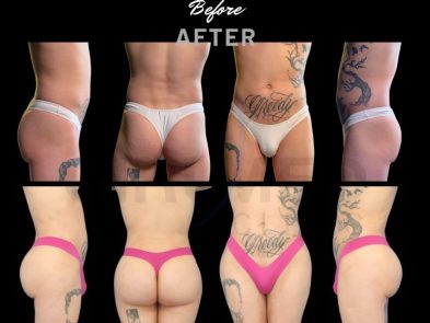 Result of buttock augmentation performed in Marbella - Spain.