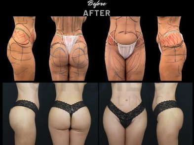 "Results of buttock augmentation surgery in Marbella, Spain."