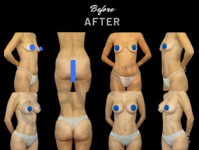 Breast augmentation and abdominal liposuction results in Marbella, Spain.