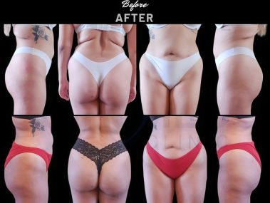 Before and after a buttock augmentation performed in Marbella, Spain.