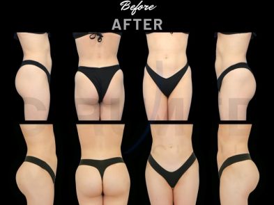 "Results of a buttock augmentation in Marbella, Spain."