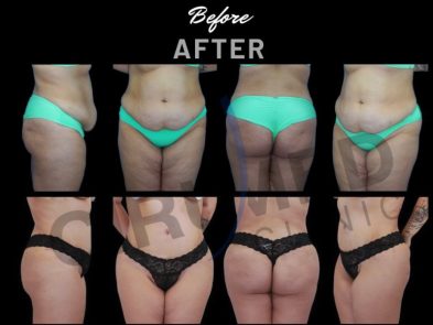"Liposuction results in Marbella, Spain, showing the patient's before and after."